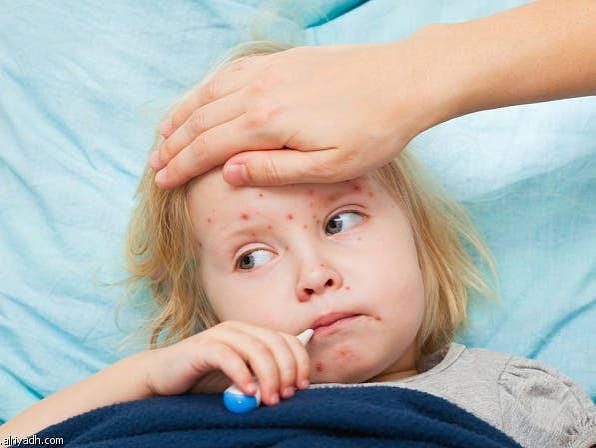 Health authorities warn of possible measles exposure at sports facilities and public venues in St. Louis, urging swift community action.